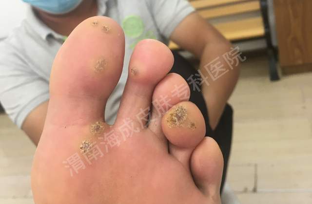 一,寻常疣中医称本病为疣目,枯筋箭,瘊子,鼠乳,水瘊