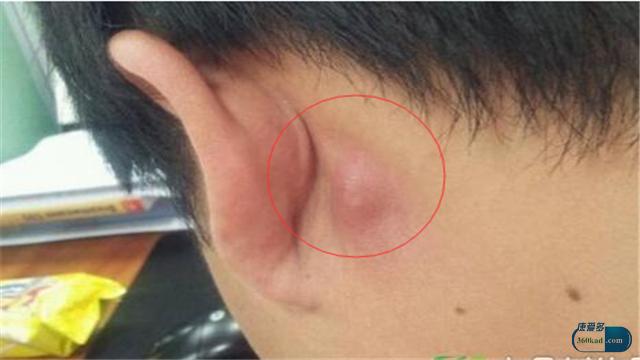 淋巴结肿大囊肿_健康症状网