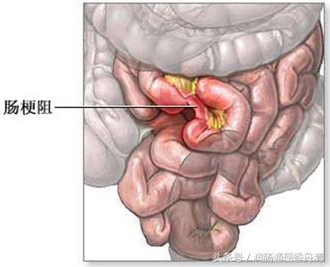 肠梗阻的症状图片