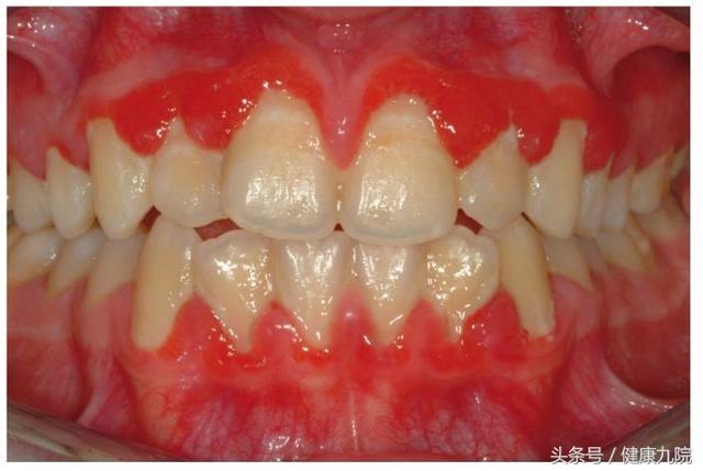谈医论症|妊娠期牙龈炎_健康症状网