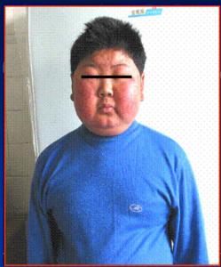 满月脸水牛背多毛痤疮都是库欣综合征的临床表现