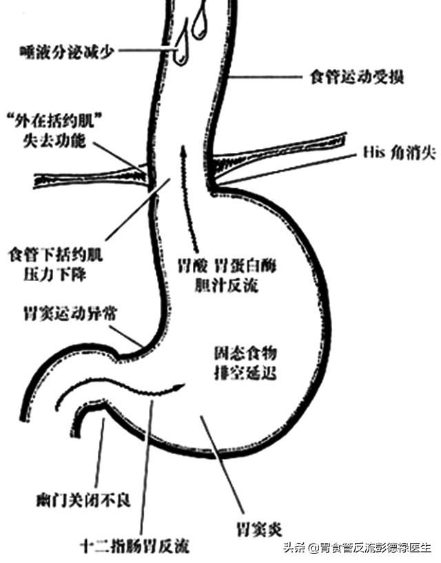 贲门松弛导致胃酸反流医生警惕小心这些疾病来找你