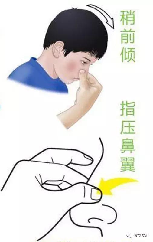 鼻子出血如何处理呢