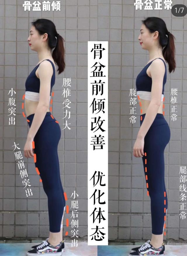骨盆前倾据说85女性都有的仪态杀手快来看看你有没有