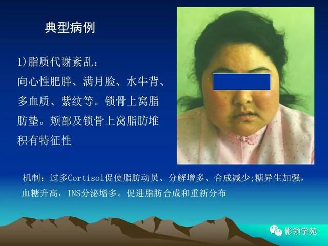 库欣综合征的诊断和治疗皮质醇增多症hypercortisolism