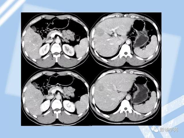 22种肝脏少见及不典型肿瘤的影像表现