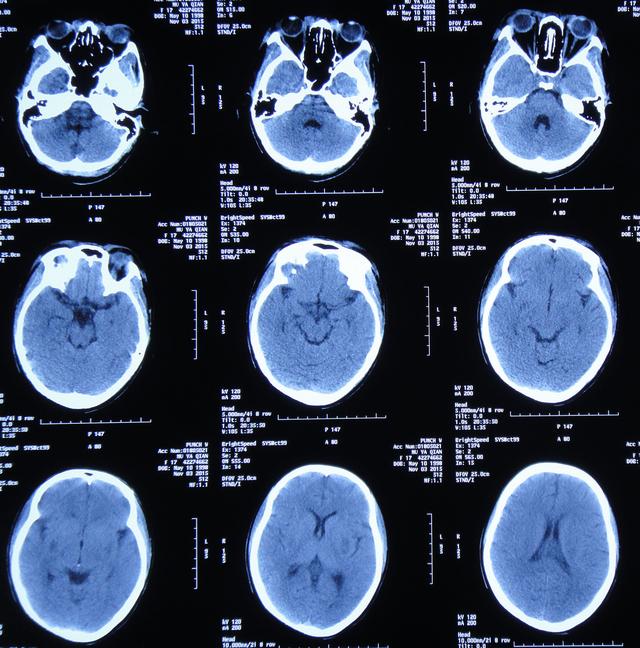 系统性红斑狼疮性脑膜脑室炎性双侧孤立颞角性脑积水 经李小勇脑脊液科治疗恢复为正常人 脑积水 脑积水