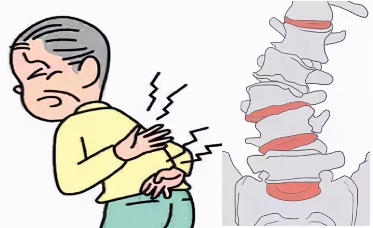 中老年人群注意了,这种腰腿痛可能提示你腰椎退变性侧弯了!