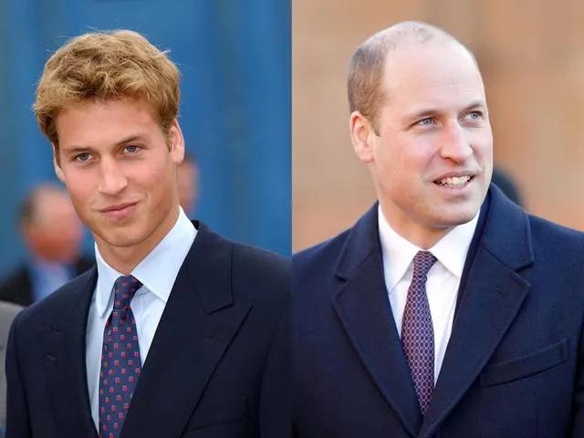 So The Standard For Baldness Is The Height Of The Hairline 7cm The Bald Representatives So The Standard For Baldness Is The Height Of The Hairline 7cm The Bald Representatives